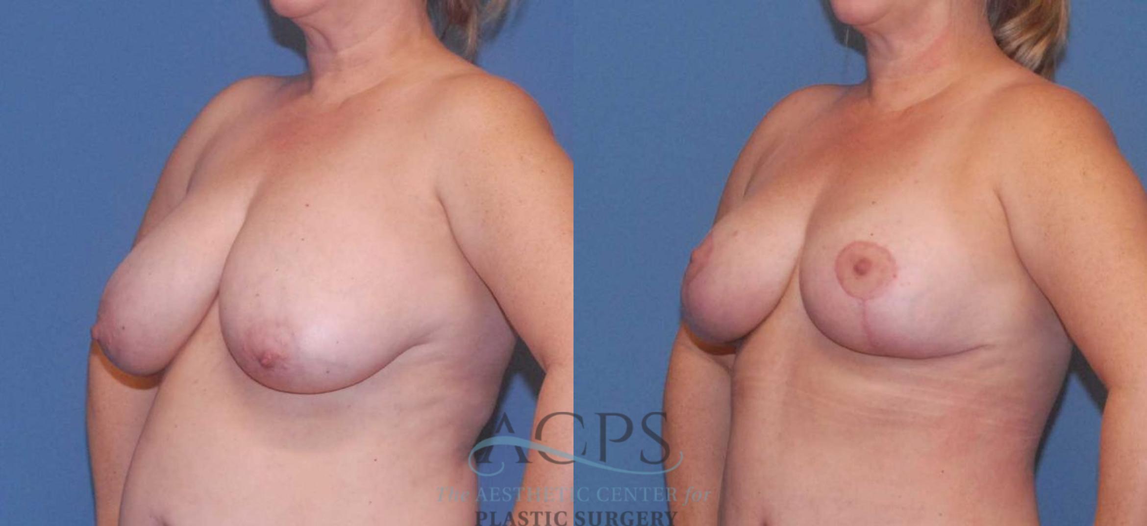 Before & After Breast Reduction Case 1160 Left Oblique View: View in Houston, TX