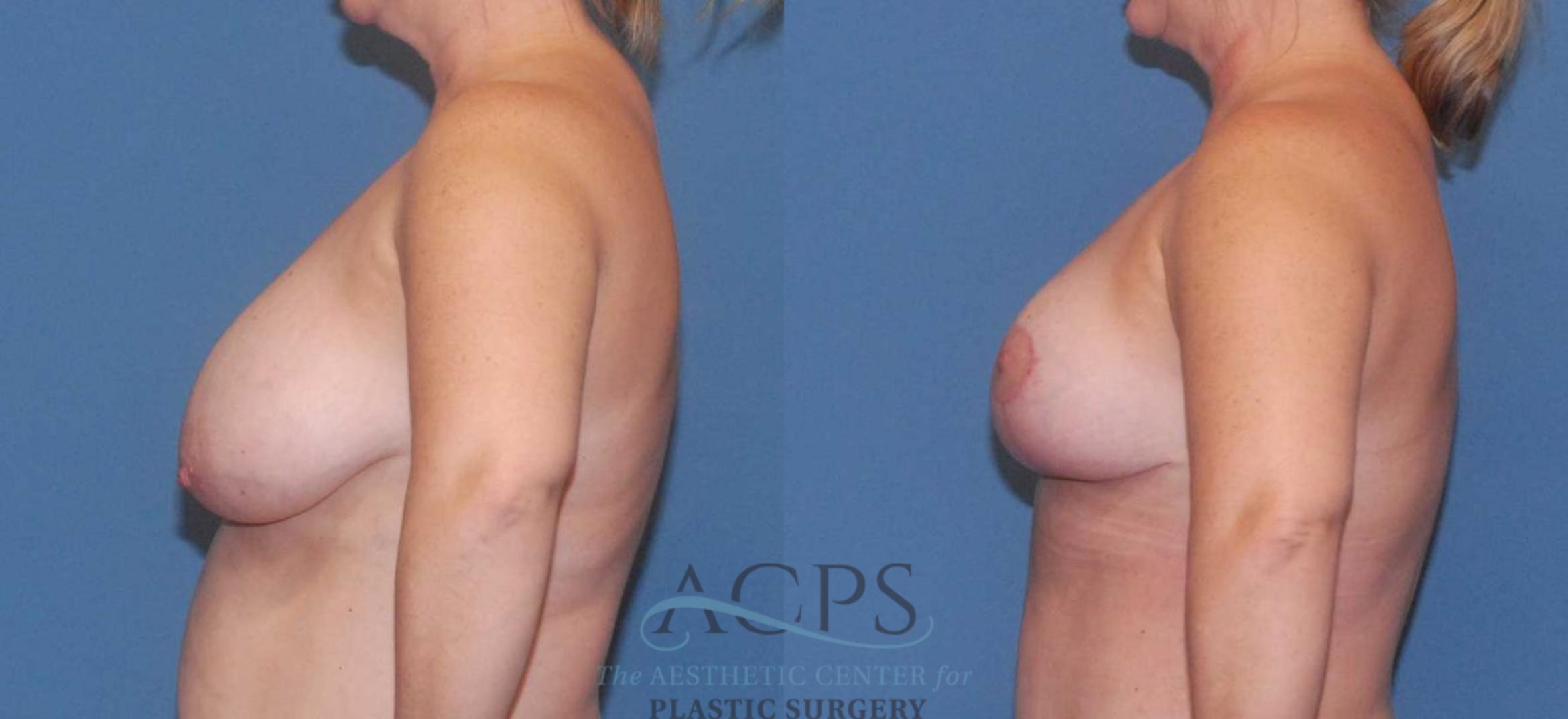 Before & After Breast Reduction Case 1160 Left Side View: View in Houston, TX