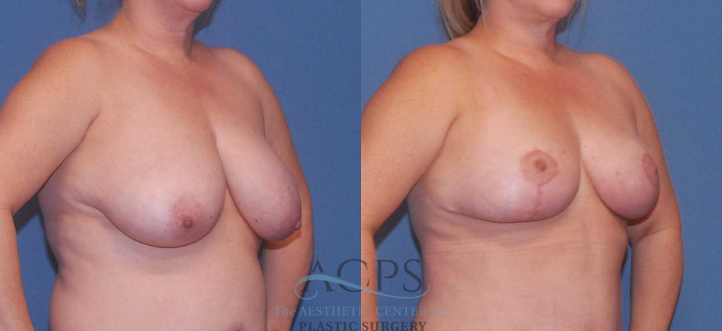 Before & After Breast Reduction Case 1160 Oblique View: View in Houston, TX