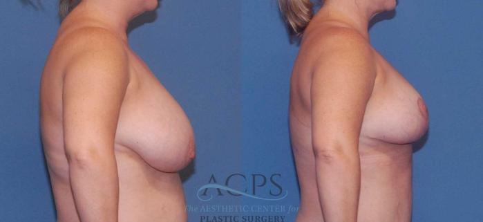 Before & After Breast Reduction Case 1160 Right Side View: View in Houston, TX