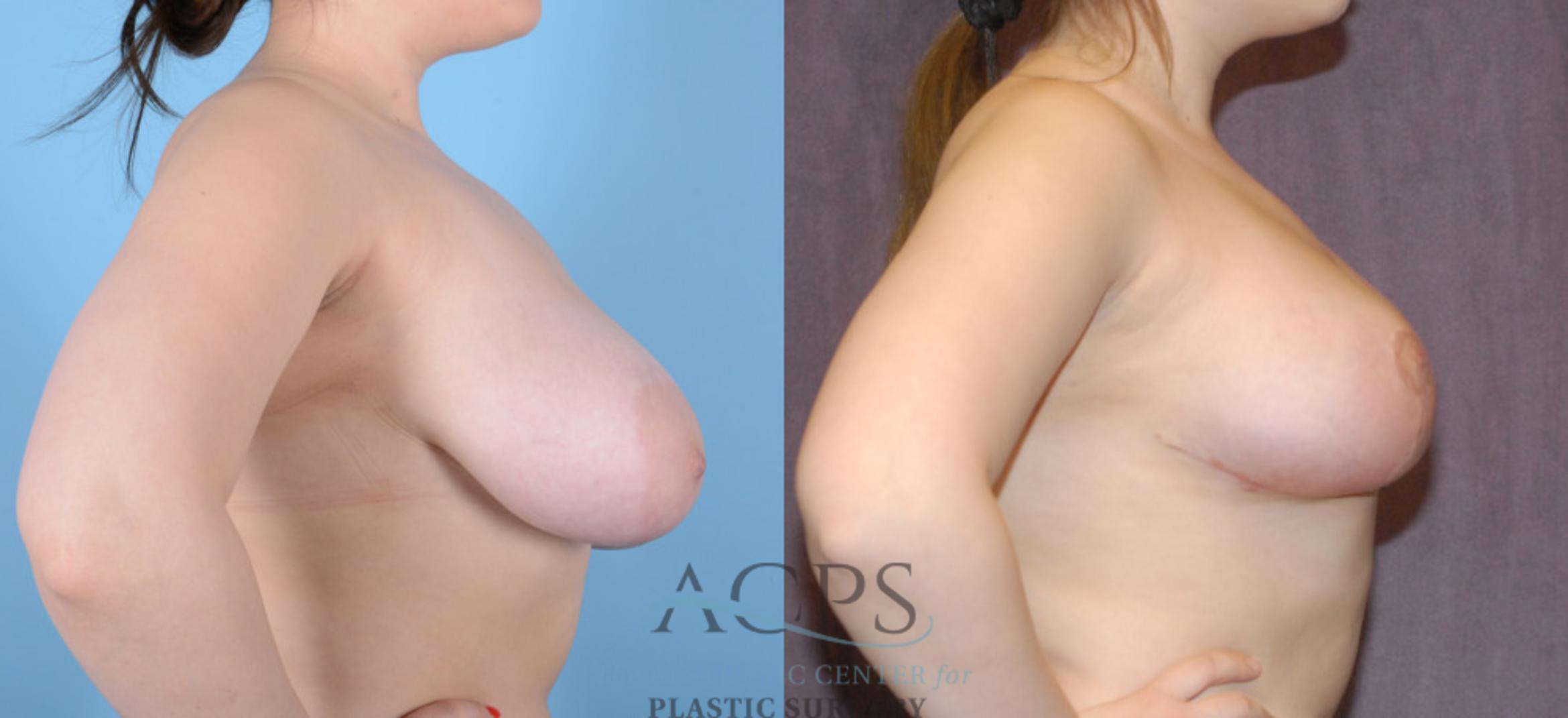 Before & After Breast Reduction Case 1161 Right Side View: View in Houston, TX