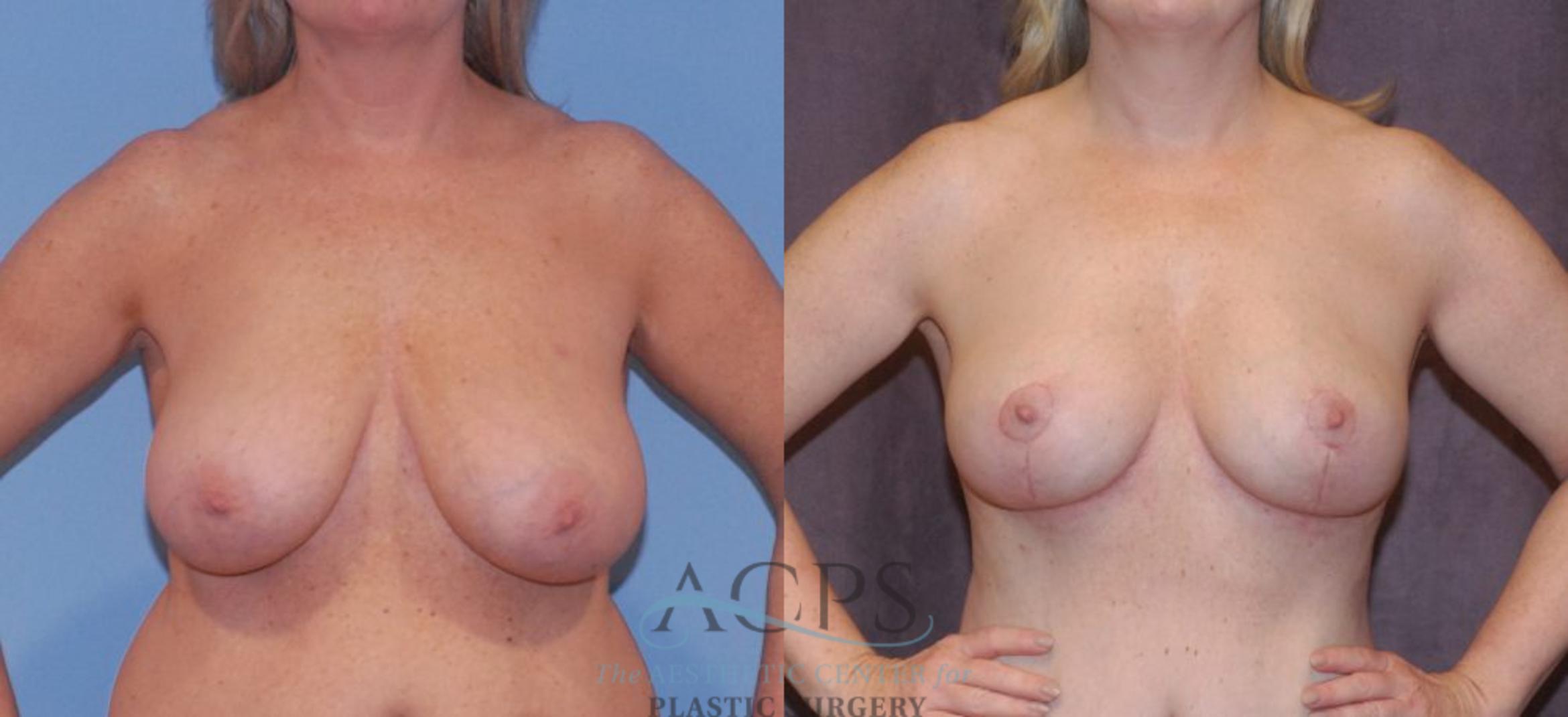 Before & After Breast Reduction Case 1162 Front View: View in Houston, TX