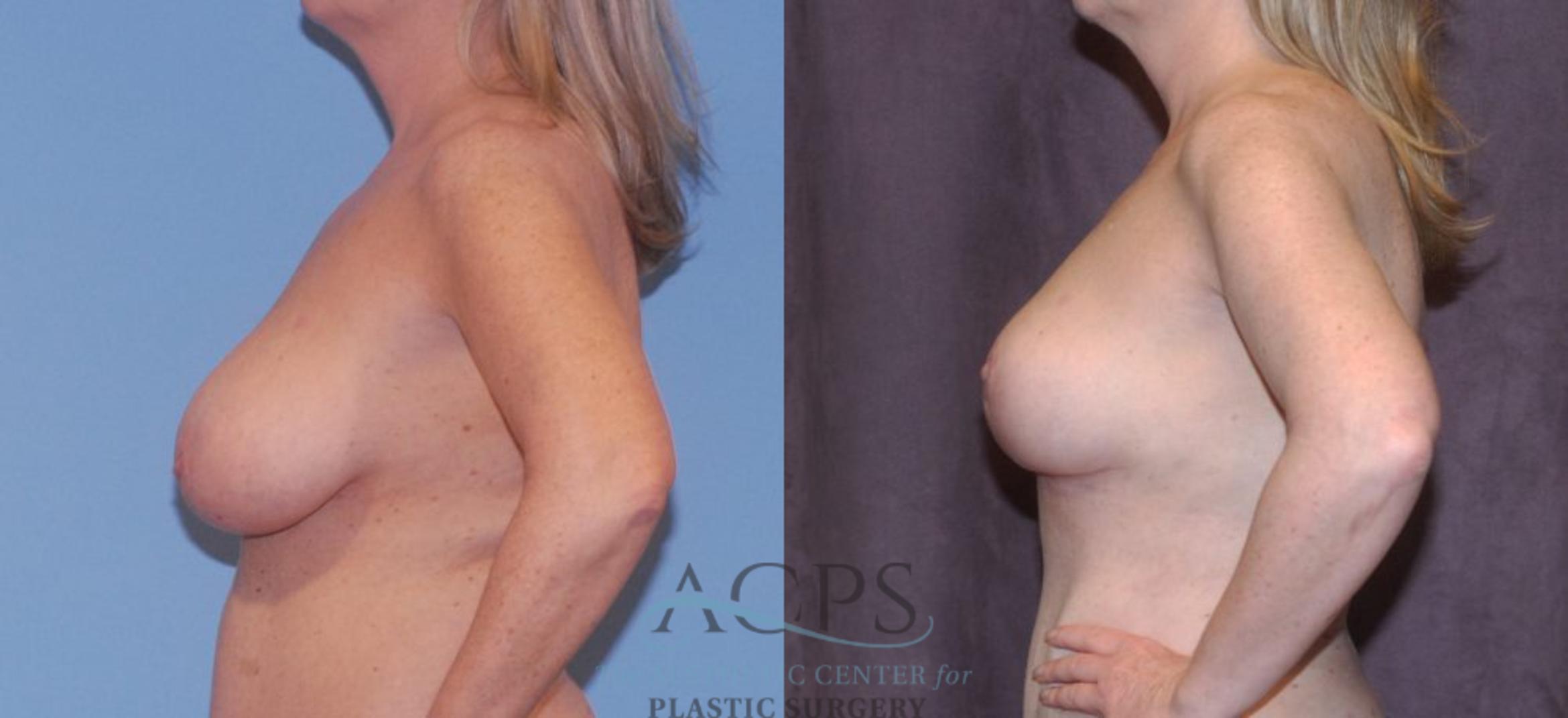Before & After Breast Reduction Case 1162 Left Side View: View in Houston, TX