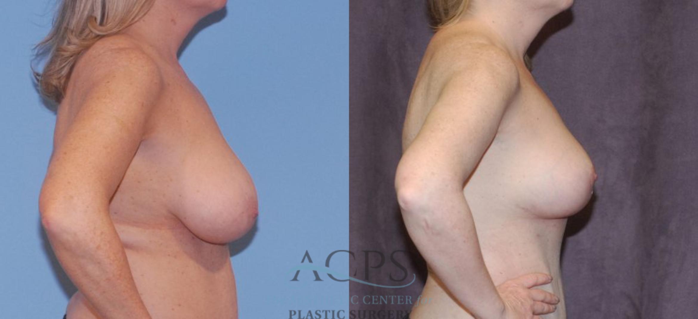 Before & After Breast Reduction Case 1162 Right Side View: View in Houston, TX