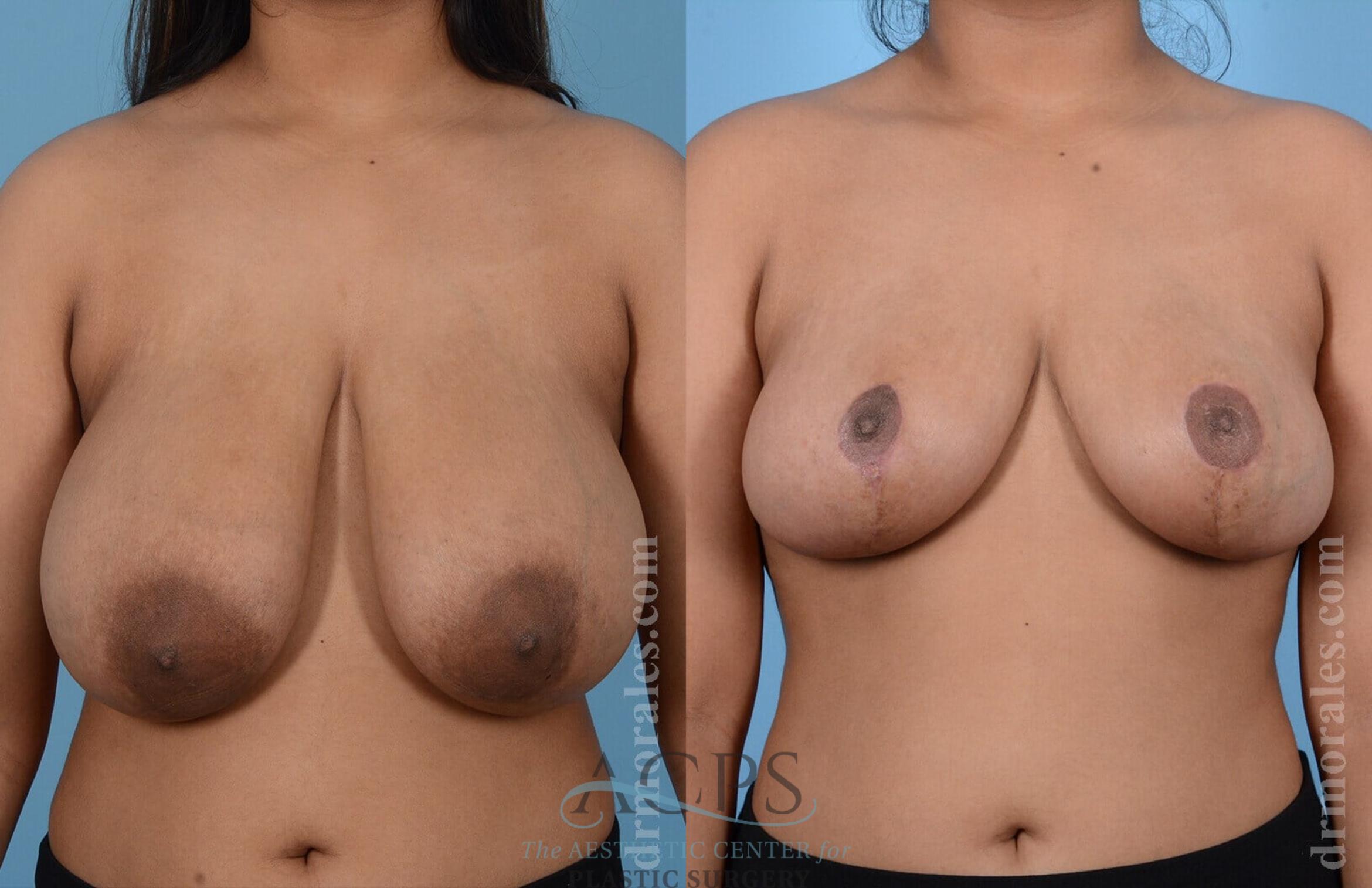 Before & After Breast Reduction Case 1164 Front View: View in Houston, TX
