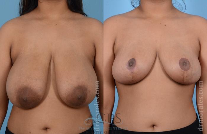 Before & After Breast Reduction Case 1164 Front View: View in Houston, TX