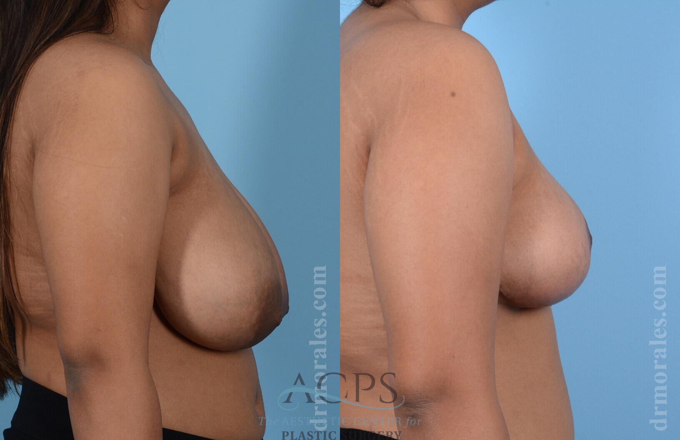 Before & After Breast Reduction Case 1164 Side View: View in Houston, TX