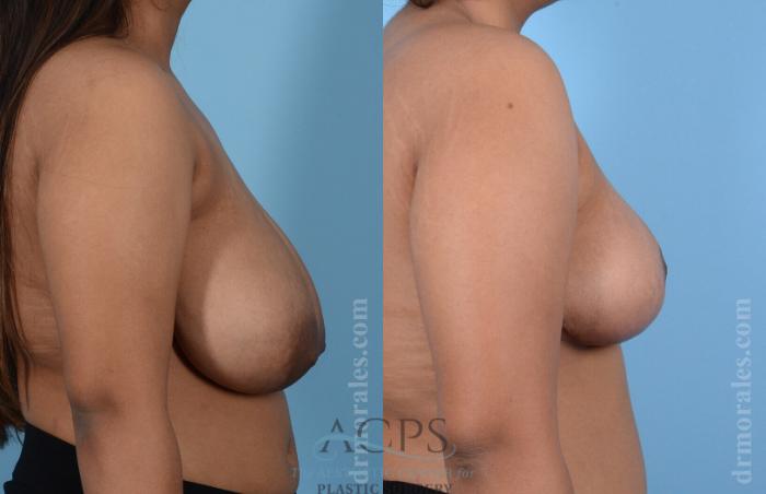 Before & After Breast Reduction Case 1164 Side View: View in Houston, TX