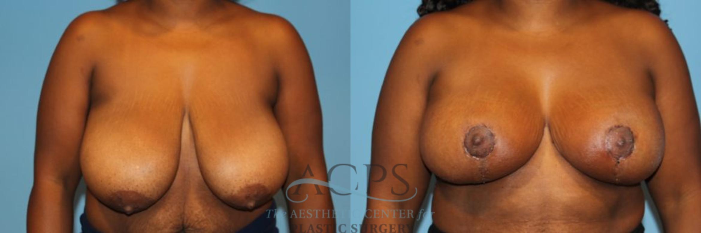 Before & After Breast Reduction Case 1165 Front View: View in Houston, TX