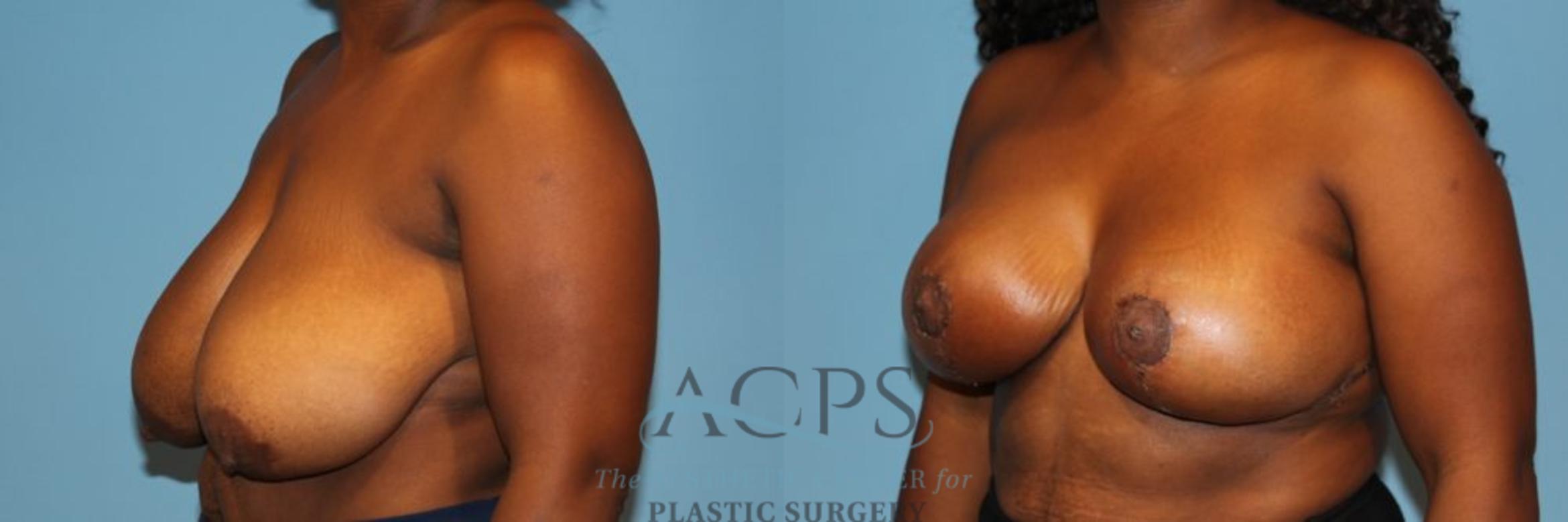 Before & After Breast Reduction Case 1165 Oblique View: View in Houston, TX