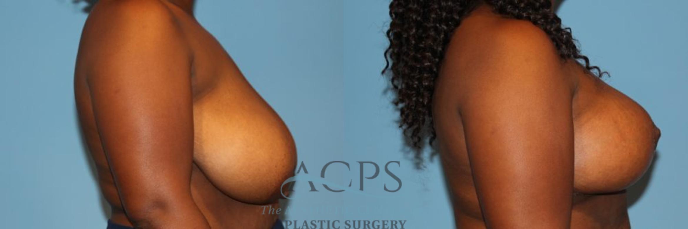 Before & After Breast Reduction Case 1165 Side View: View in Houston, TX