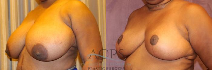 Before & After Breast Reduction Case 1166 Oblique View: View in Houston, TX