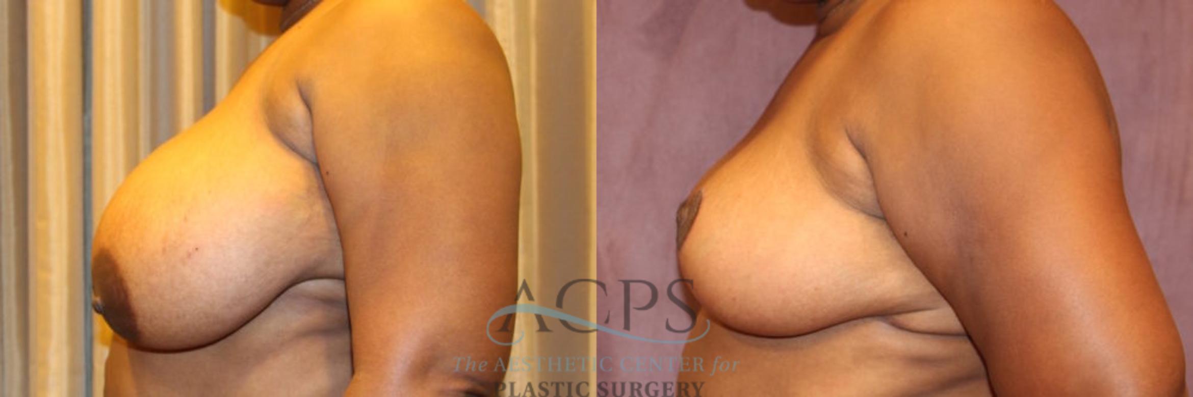 Before & After Breast Reduction Case 1166 Side View: View in Houston, TX