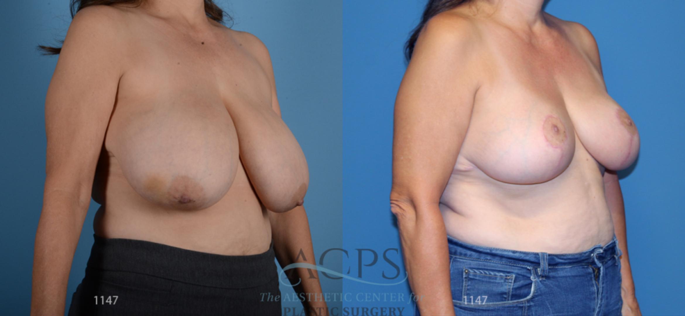Before & After Breast Reduction Case 1167 Oblique View: View in Houston, TX