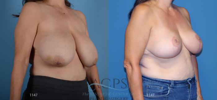 Before & After Breast Reduction Case 1167 Oblique View: View in Houston, TX