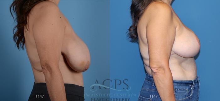 Before & After Breast Reduction Case 1167 Side View: View in Houston, TX