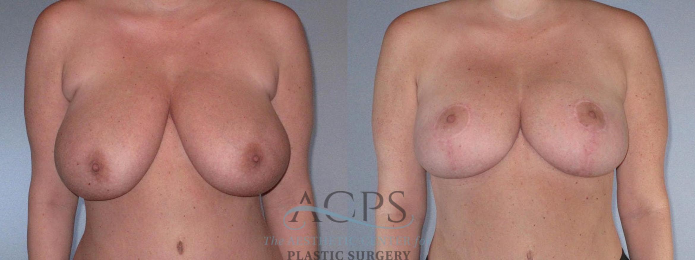 Before & After Breast Reduction Case 1169 Front View: View in Houston, TX