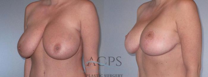 Before & After Breast Reduction Case 1169 Left Oblique View: View in Houston, TX
