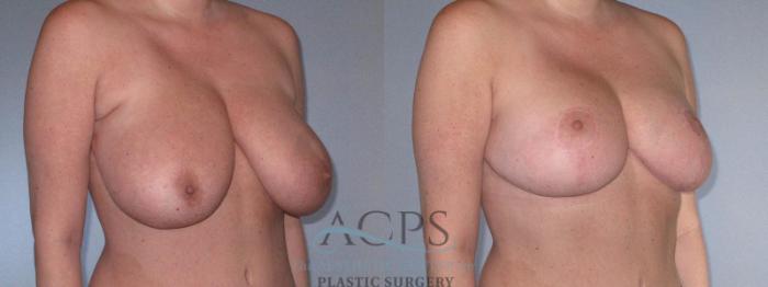 Before & After Breast Reduction Case 1169 Oblique View: View in Houston, TX