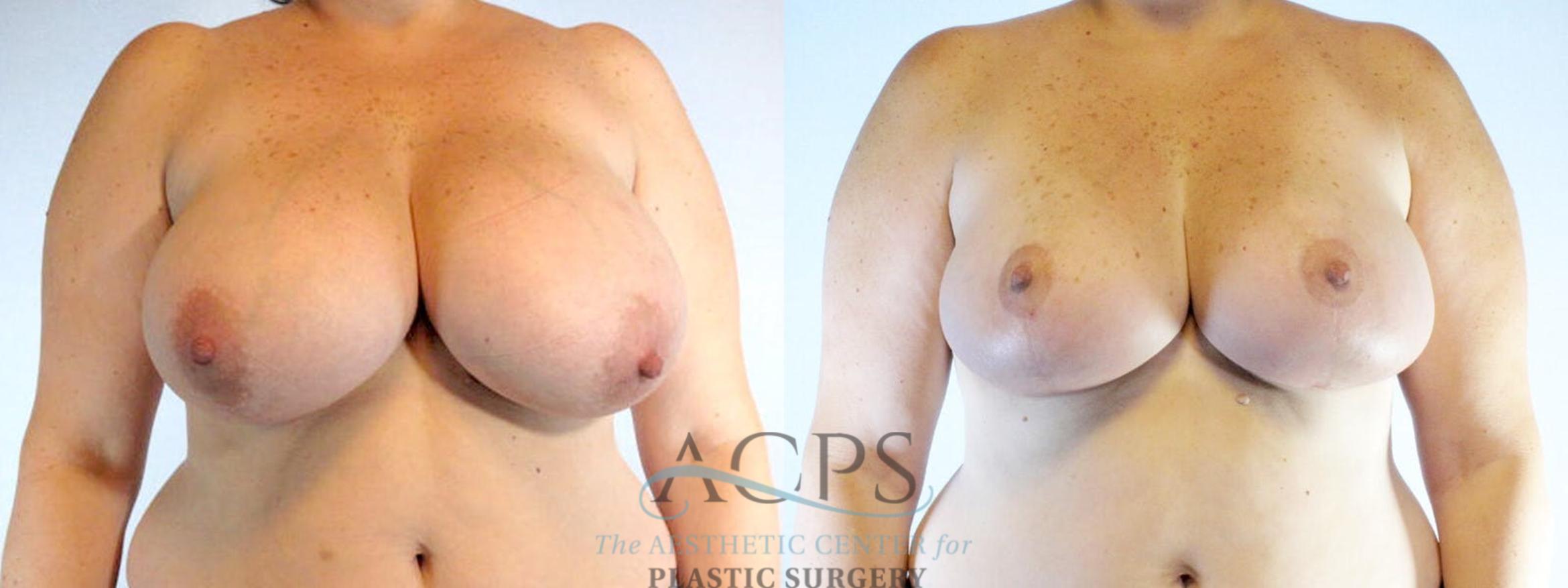 Before & After Breast Reduction Case 1170 Front View: View in Houston, TX