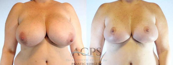 Before & After Breast Reduction Case 1170 Front View: View in Houston, TX