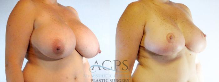 Before & After Breast Reduction Case 1170 Oblique View: View in Houston, TX
