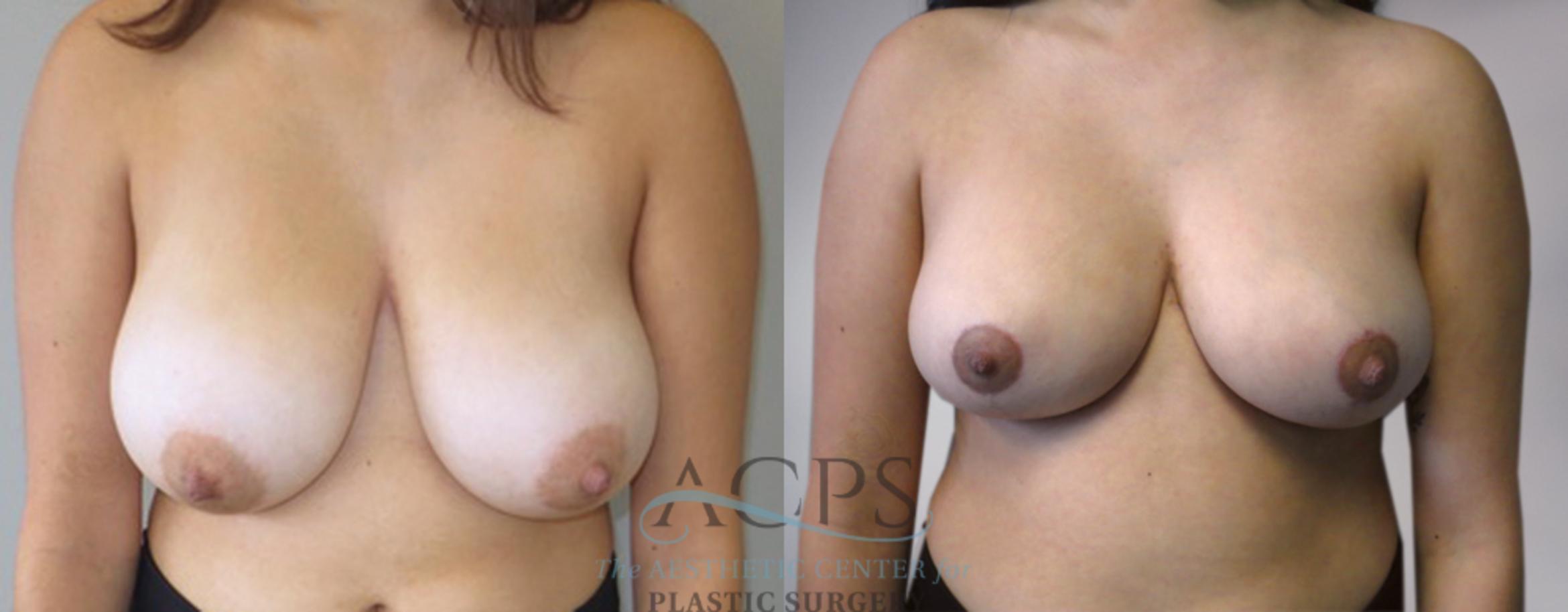 Before & After Breast Reduction Case 1171 View: View in Houston, TX