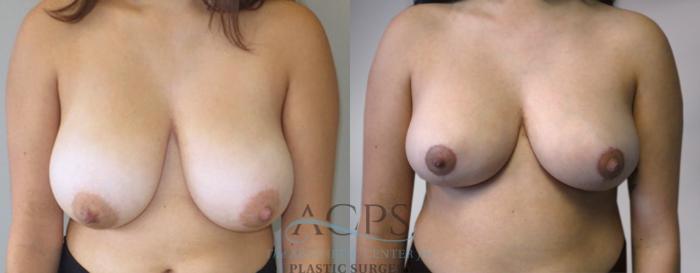 Before & After Breast Reduction Case 1171 View: View in Houston, TX