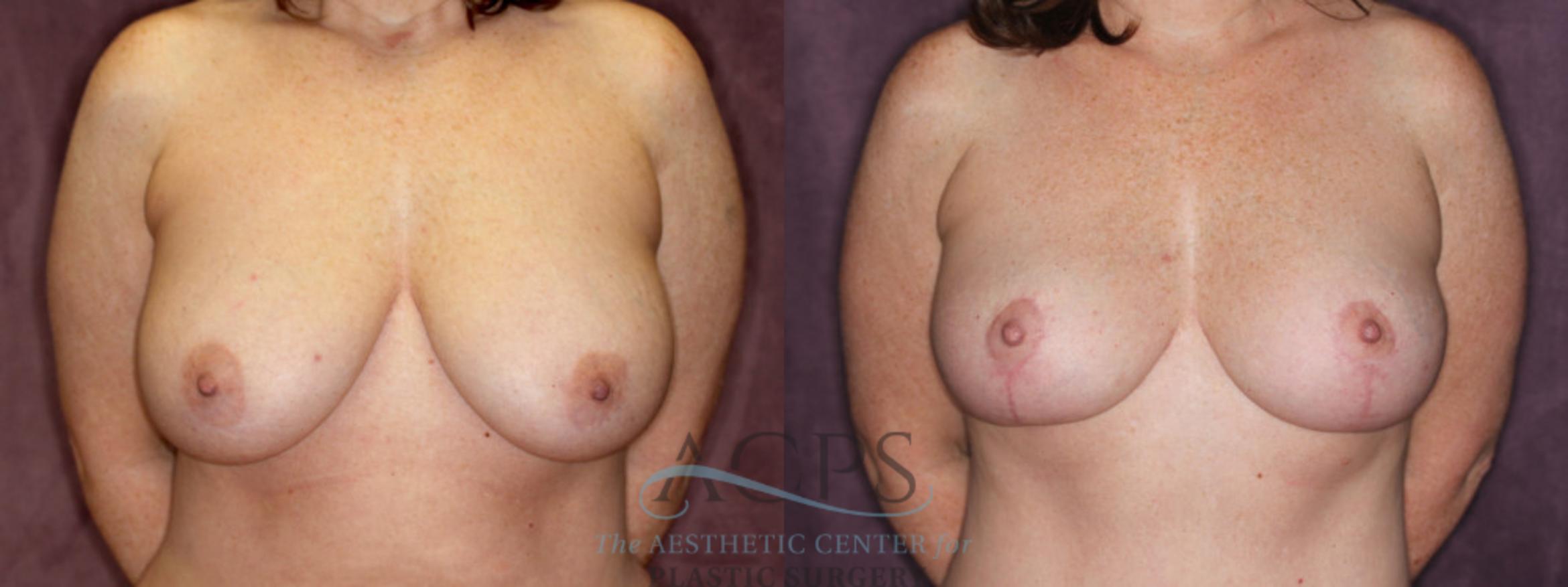 Before & After Breast Reduction Case 1172 Front View: View in Houston, TX
