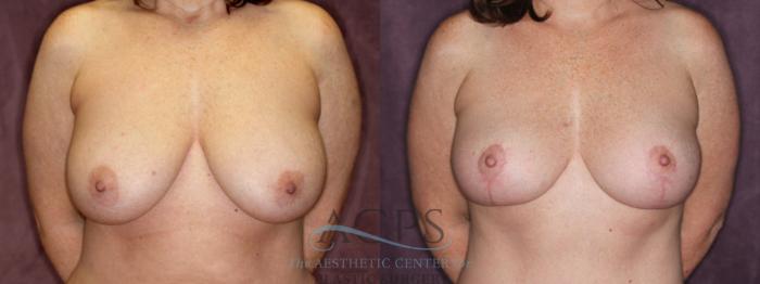 Before & After Breast Reduction Case 1172 Front View: View in Houston, TX