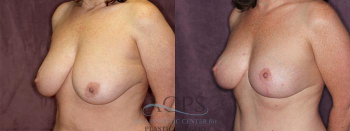 Before & After Breast Reduction Case 1172 Oblique Left View: View in Houston, TX