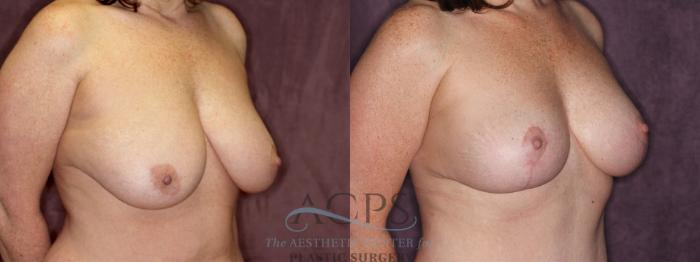 Before & After Breast Reduction Case 1172 Oblique Right View: View in Houston, TX
