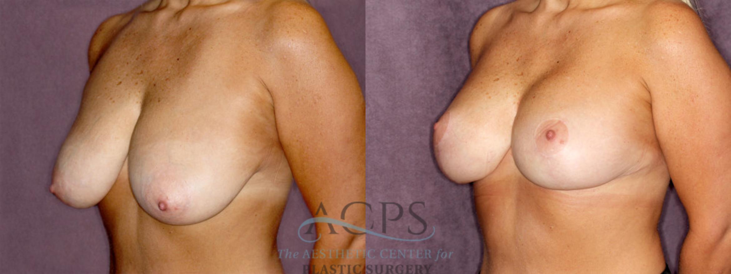 Before & After Breast Reduction Case 1173 Oblique Left View: View in Houston, TX