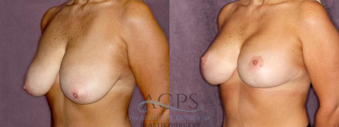 Before & After Breast Reduction Case 1173 Oblique Left View: View in Houston, TX