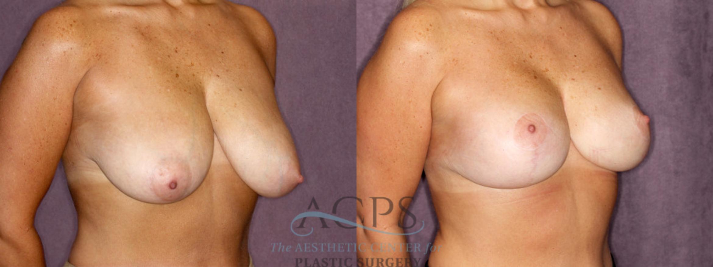 Before & After Breast Reduction Case 1173 Oblique Right View: View in Houston, TX