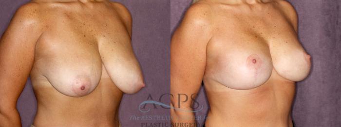 Before & After Breast Reduction Case 1173 Oblique Right View: View in Houston, TX