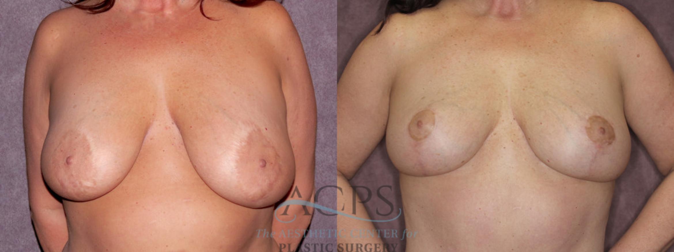 Before & After Breast Reduction Case 1174 Front View: View in Houston, TX