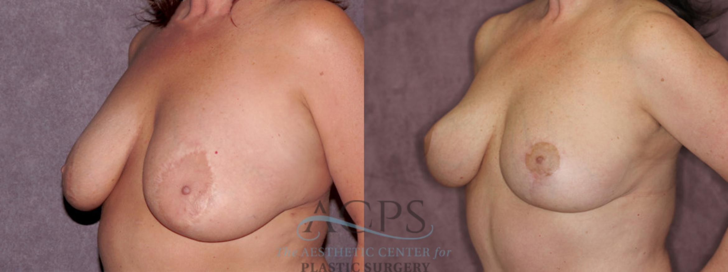 Before & After Breast Reduction Case 1174 Oblique Left View: View in Houston, TX