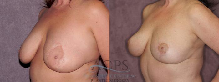 Before & After Breast Reduction Case 1174 Oblique Left View: View in Houston, TX
