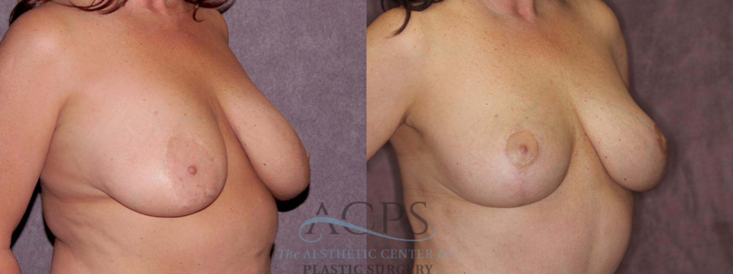 Before & After Breast Reduction Case 1174 Oblique Right View: View in Houston, TX