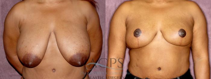 Before & After Breast Reduction Case 1175 Front View: View in Houston, TX