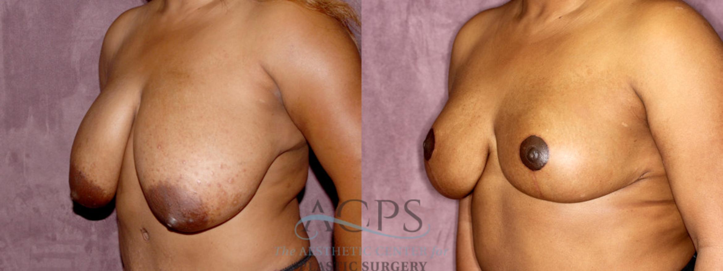 Before & After Breast Reduction Case 1175 Oblique Left View: View in Houston, TX