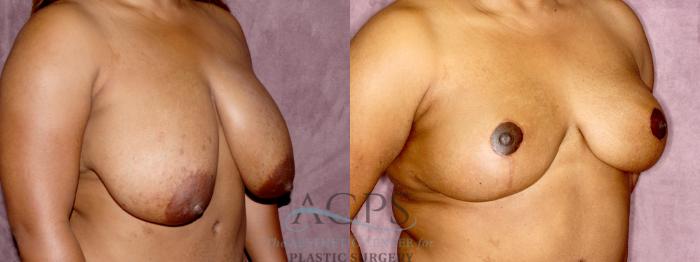 Before & After Breast Reduction Case 1175 Oblique Right View: View in Houston, TX