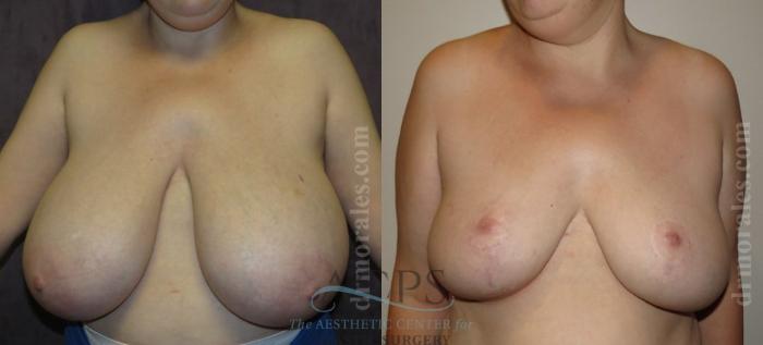 Before & After Breast Reduction Case 1188 Front View: View in Houston, TX