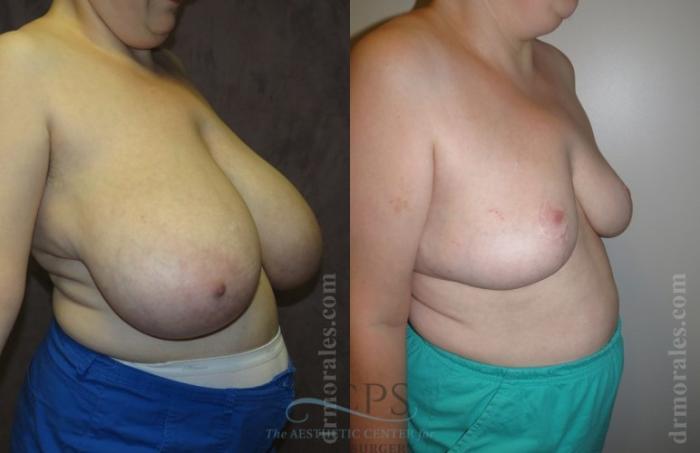 Before & After Breast Reduction Case 1188 Oblique View: View in Houston, TX