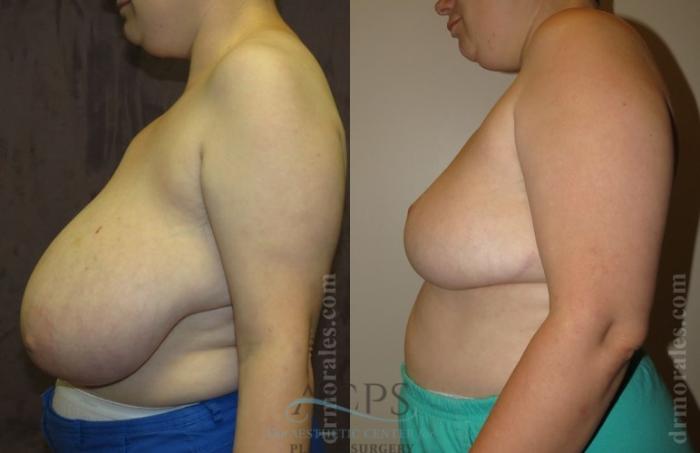 Before & After Breast Reduction Case 1188 Side View: View in Houston, TX