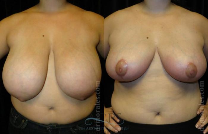 Before & After Breast Reduction Case 1189 Front View: View in Houston, TX