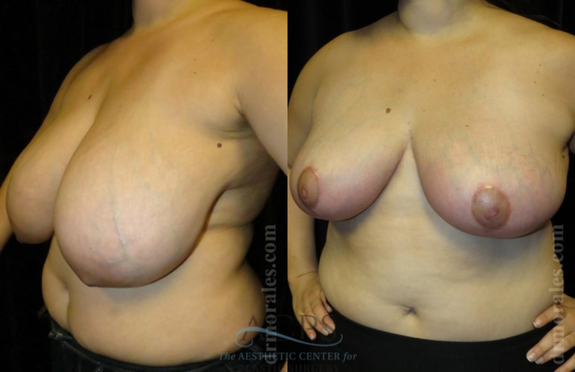 Before & After Breast Reduction Case 1189 Oblique View: View in Houston, TX