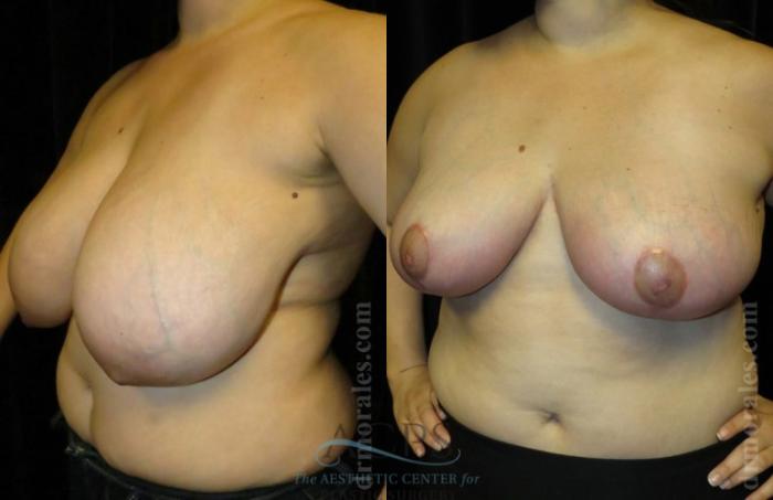 Before & After Breast Reduction Case 1189 Oblique View: View in Houston, TX