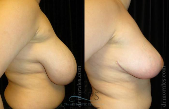 Before & After Breast Reduction Case 1189 Side View: View in Houston, TX